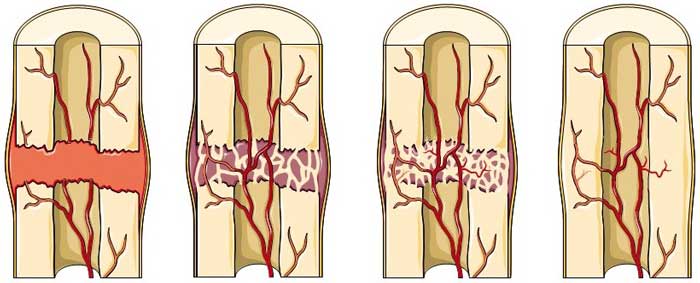 Healing-of-fractured-bone